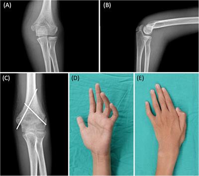 Case Report: Supercharged end-to-side anterior interosseous to ulnar motor nerve transfer for ulnar nerve neuropathy after cross pinning of pediatric supracondylar humerus fracture